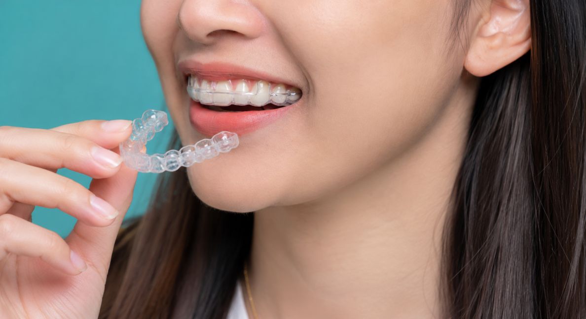 Close-up of an adult patient with teeth that shifted after braces using clear Invisalign aligners to restore proper alignment